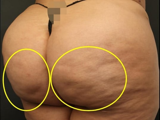 Avéli Cellulite Procedure Before