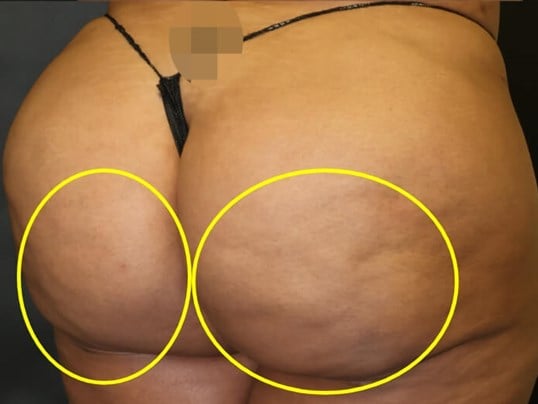 Avéli Cellulite Procedure After