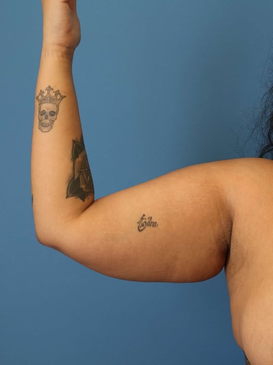 Awake Arm Liposuction Before