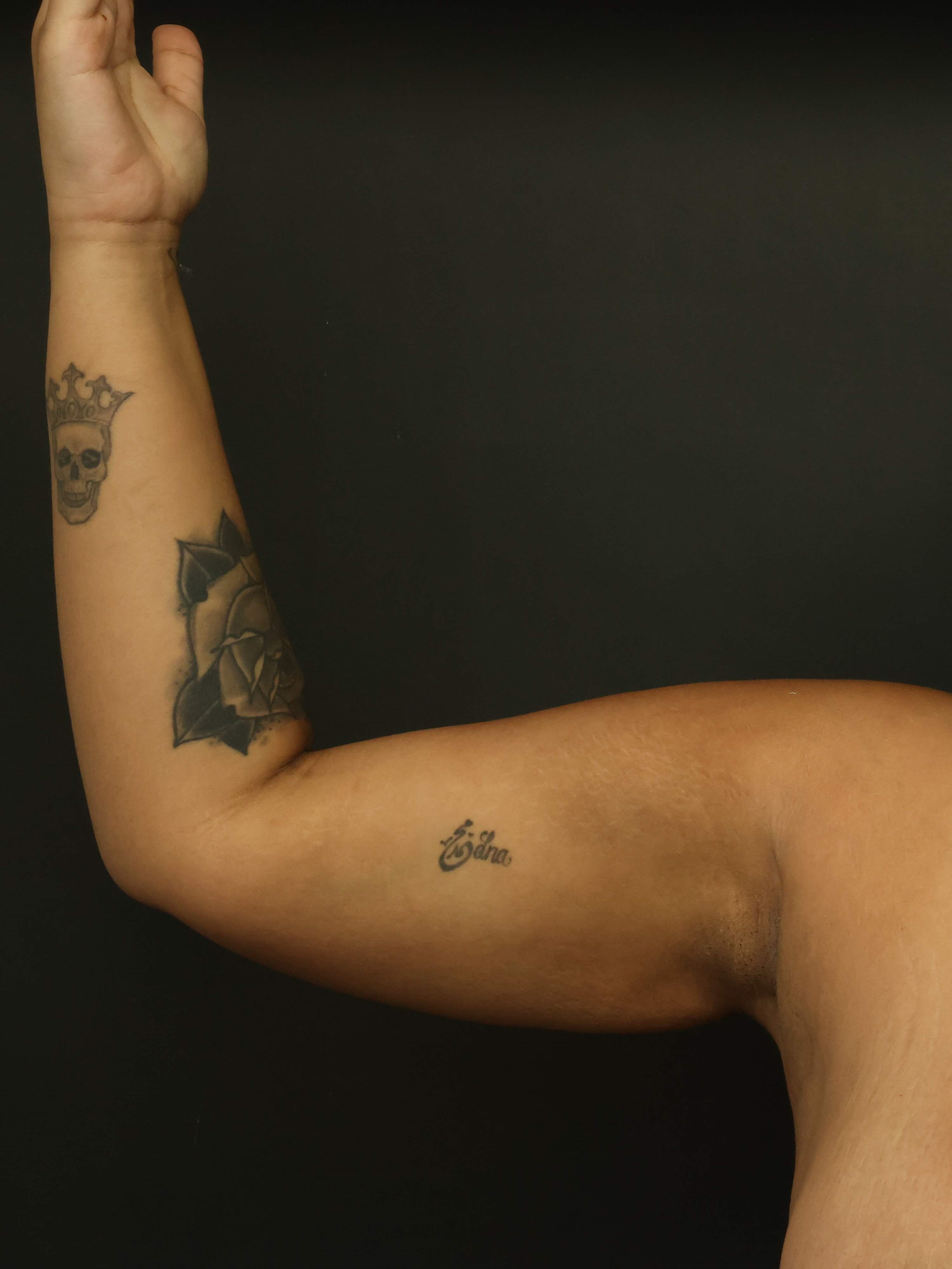 Awake Arm Liposuction After