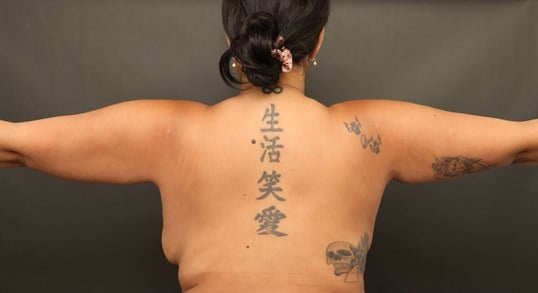 Awake Arm Liposuction After