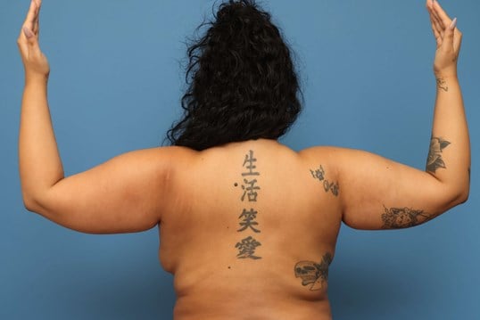 Awake Arm Liposuction Before