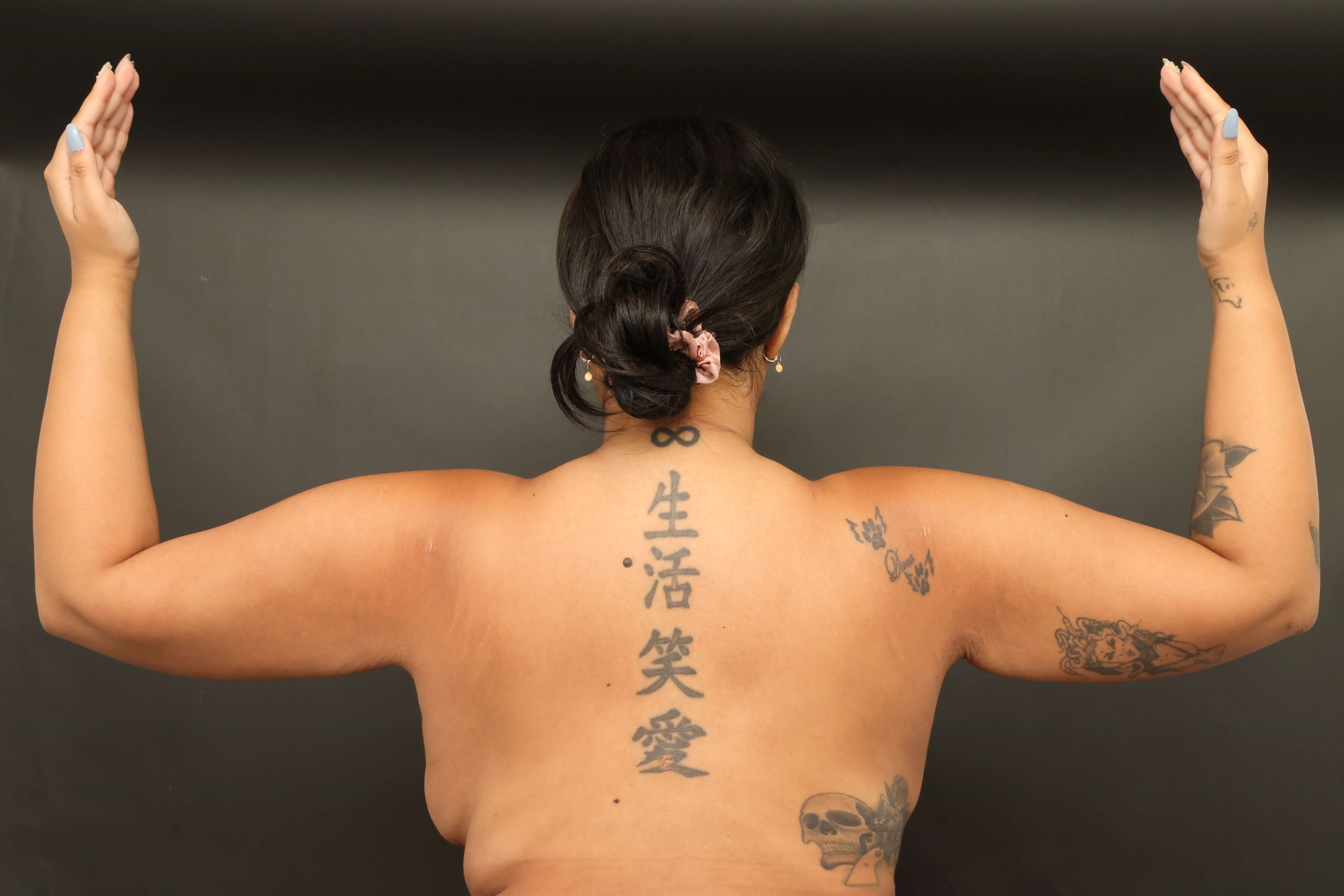 Awake Arm Liposuction After