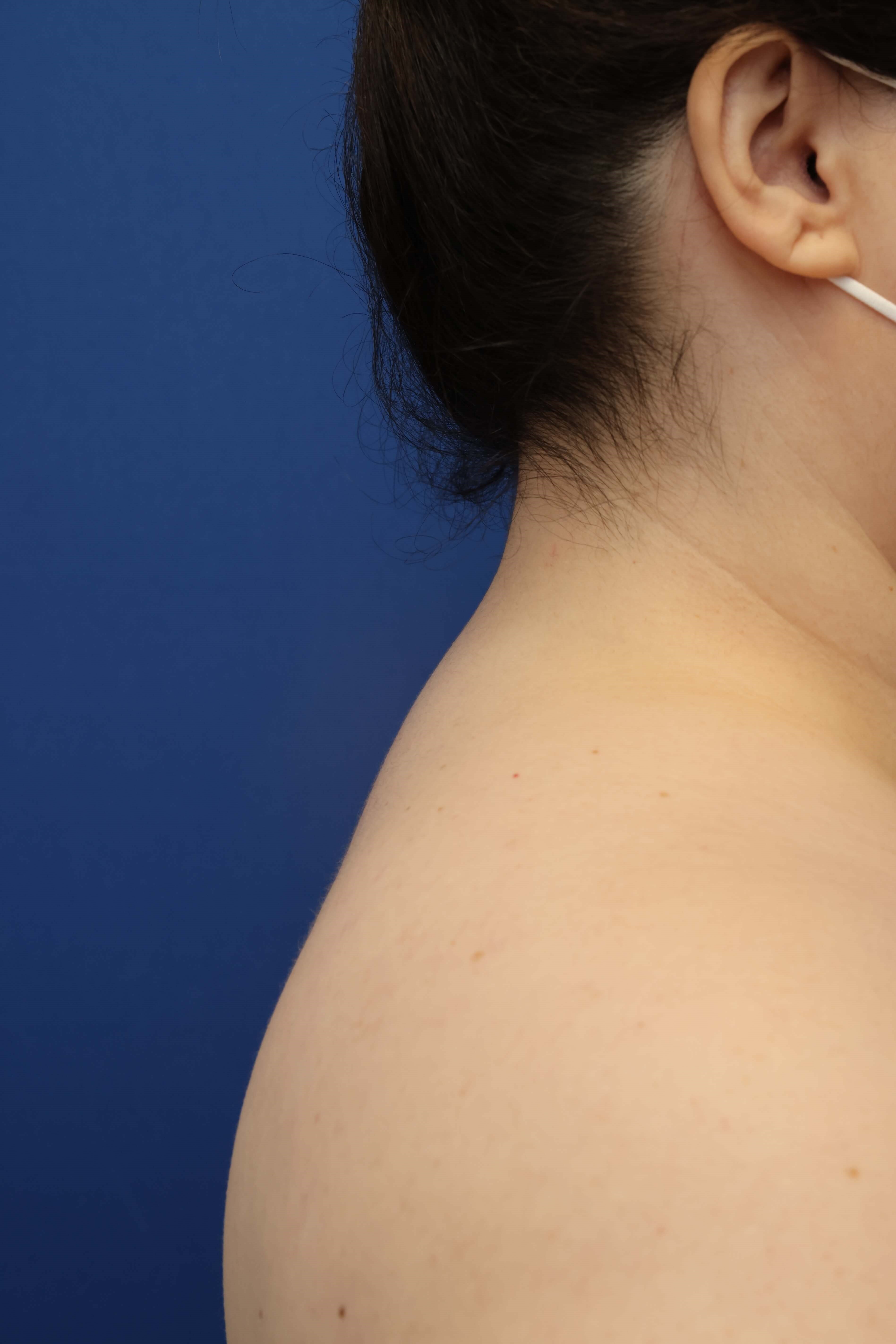 Awake Buffalo Hump Liposuction After