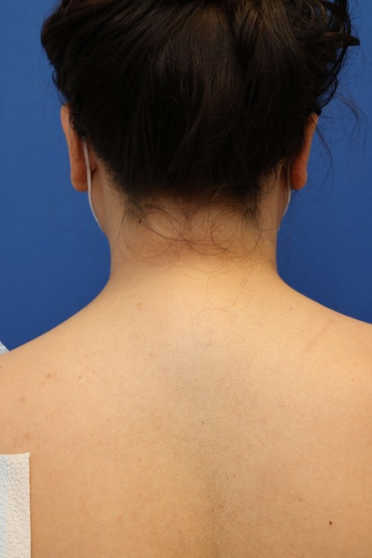 Awake Buffalo Hump Liposuction Before