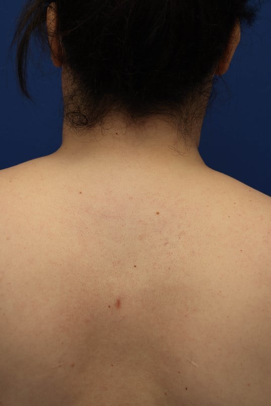 Awake Buffalo Hump Liposuction After