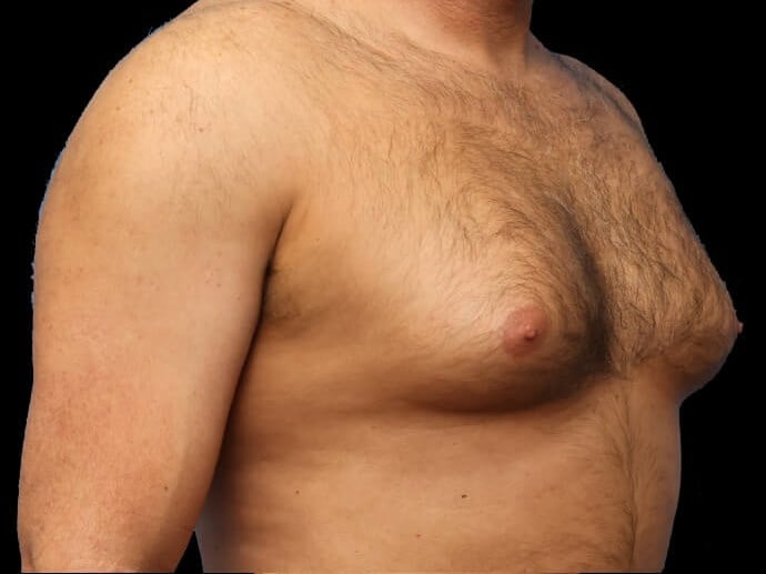 Awake Chest Liposuction Before