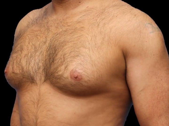 Awake Chest Liposuction Before