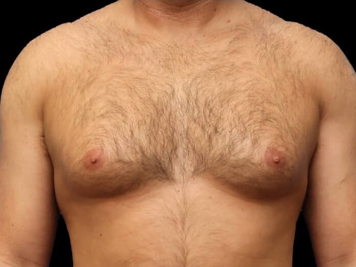 Awake Chest Liposuction Before