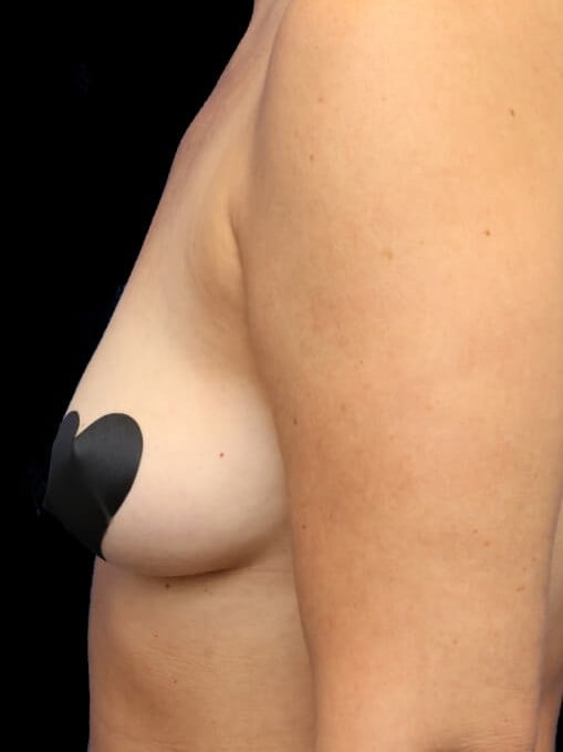 Awake Fat Transfer to Breasts Before