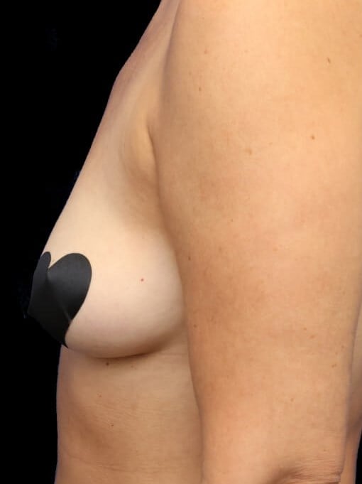 Awake Fat Transfer to Breasts Before