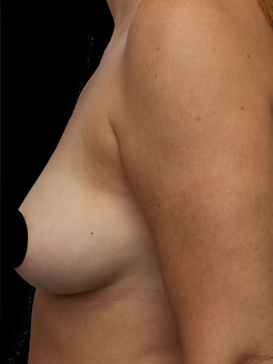 Awake Fat Transfer to Breasts After
