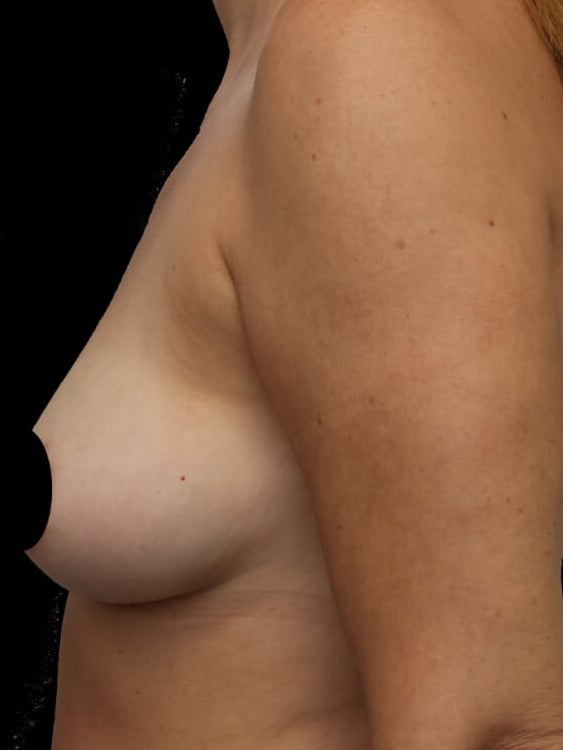 Awake Fat Transfer to Breasts After