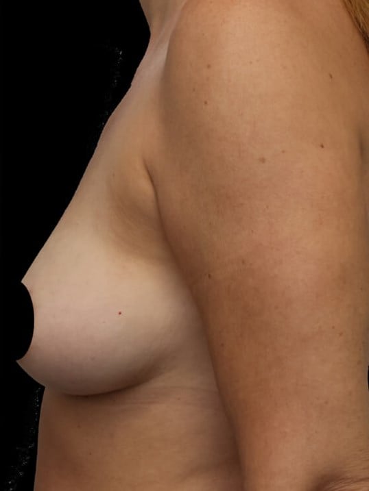 Awake Fat Transfer to Breasts After