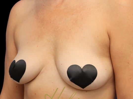 Awake Fat Transfer to Breasts Before