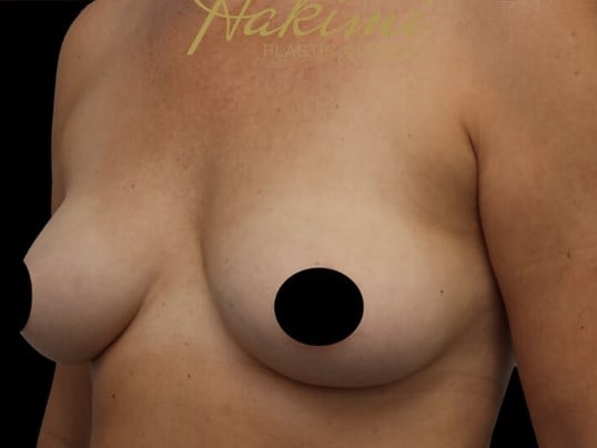 Awake Fat Transfer to Breasts After