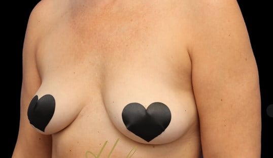 Awake Fat Transfer to Breasts Before