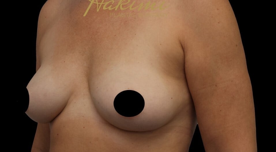 Awake Fat Transfer to Breasts After