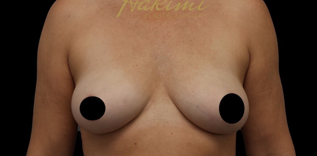 Awake Fat Transfer to Breasts After