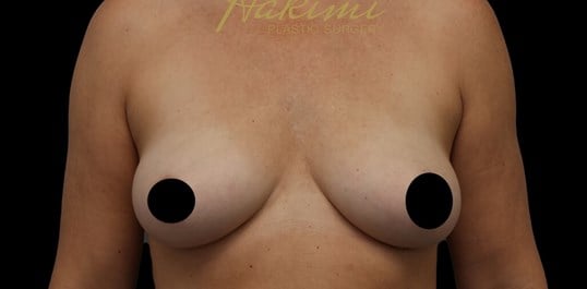 Awake Fat Transfer to Breasts After