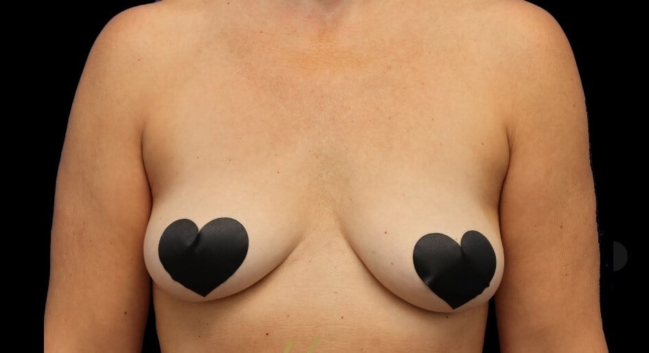 Awake Fat Transfer to Breasts Before