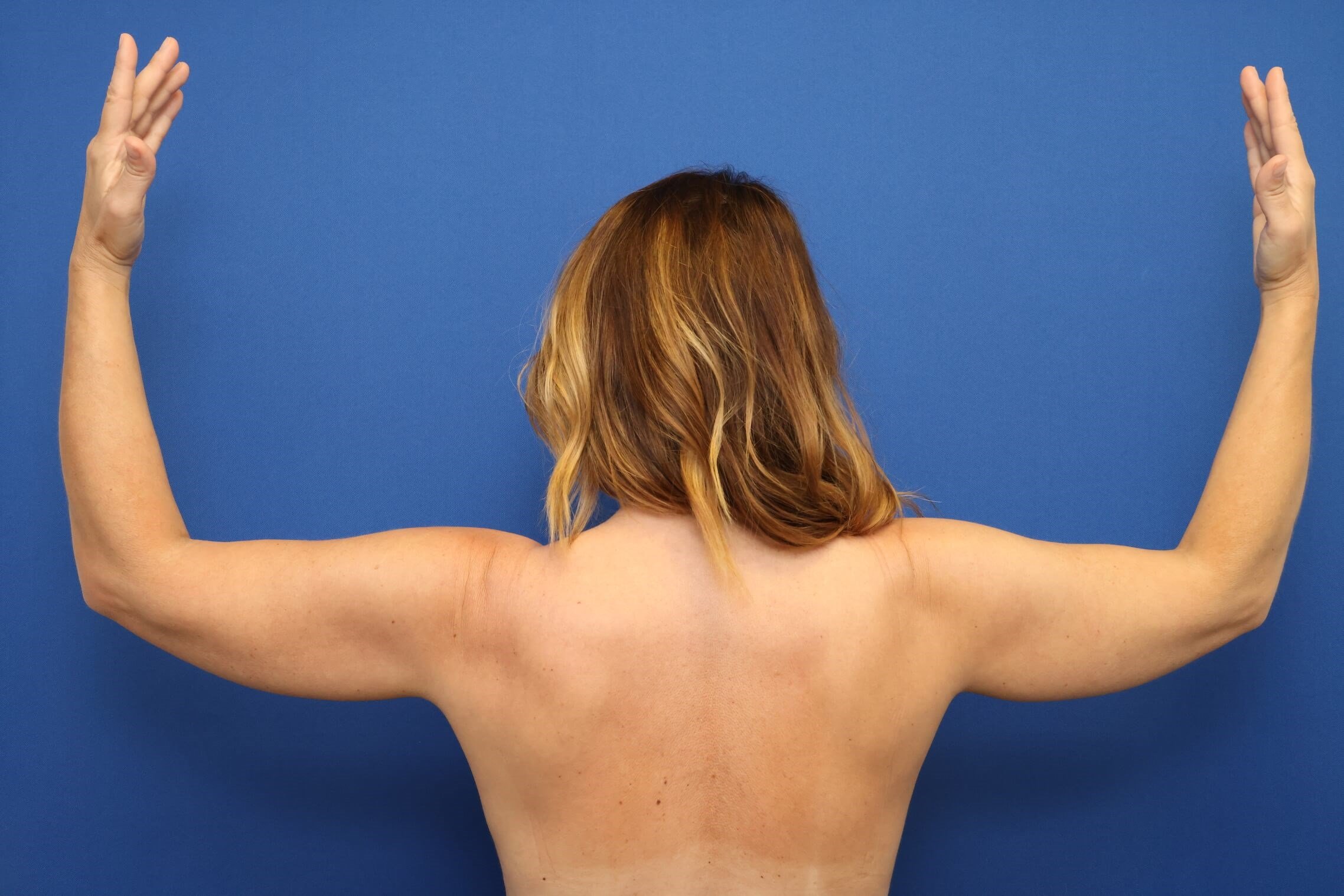 Awake Arm Liposuction Before