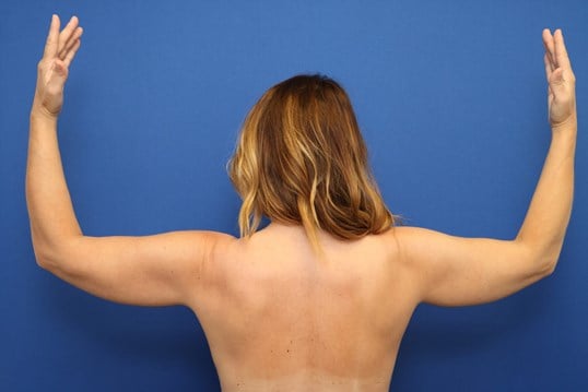 Awake Arm Liposuction Before