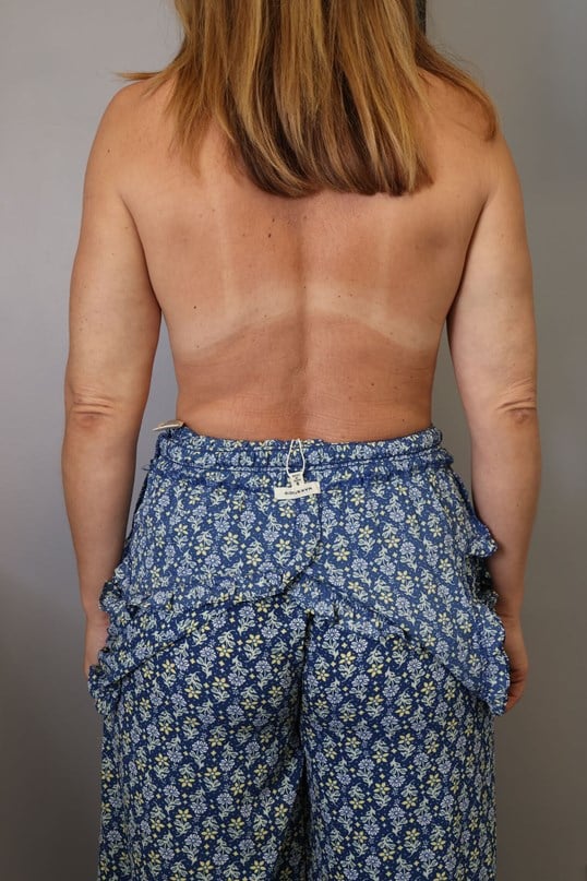 Awake Arm Liposuction After