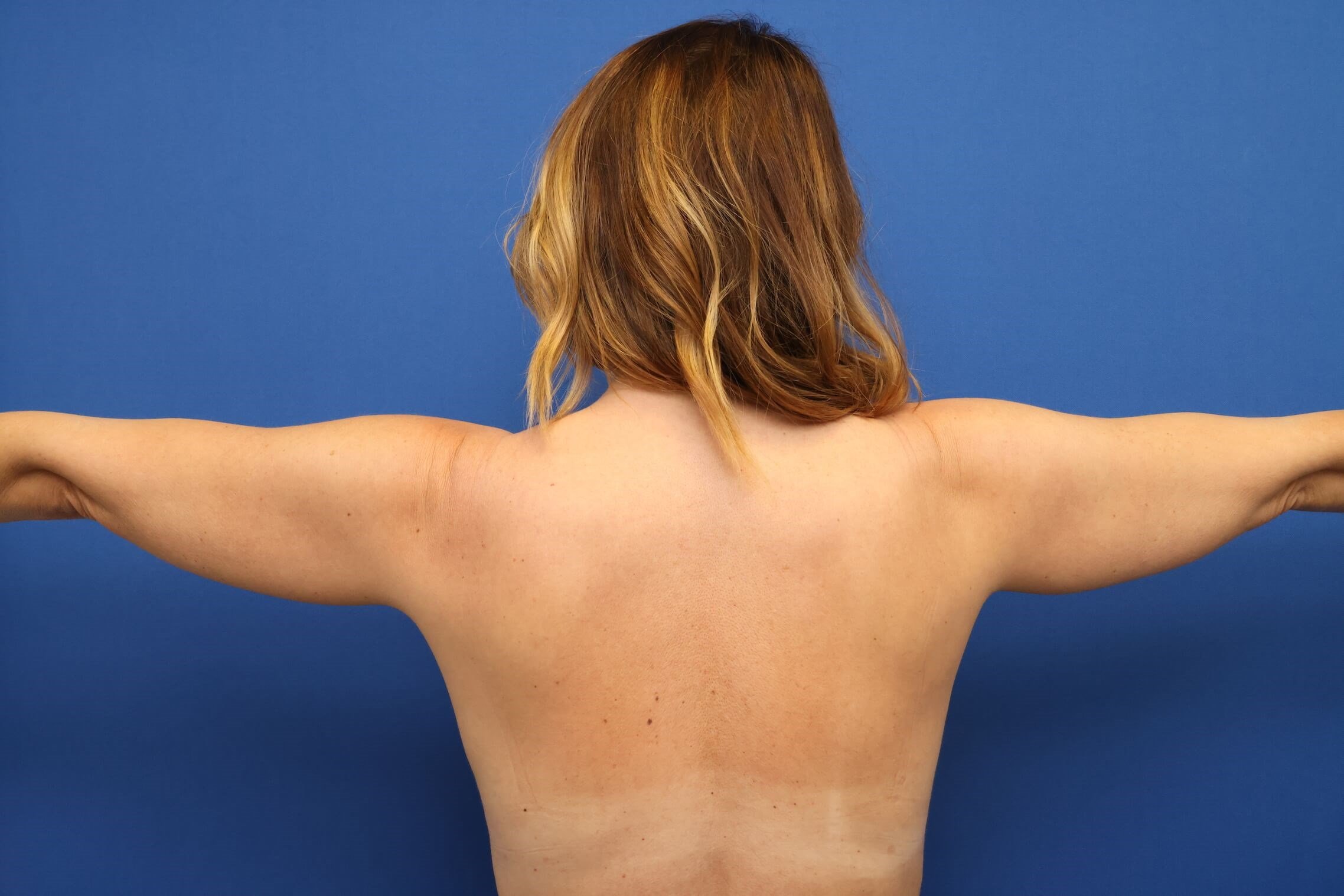 Awake Arm Liposuction Before
