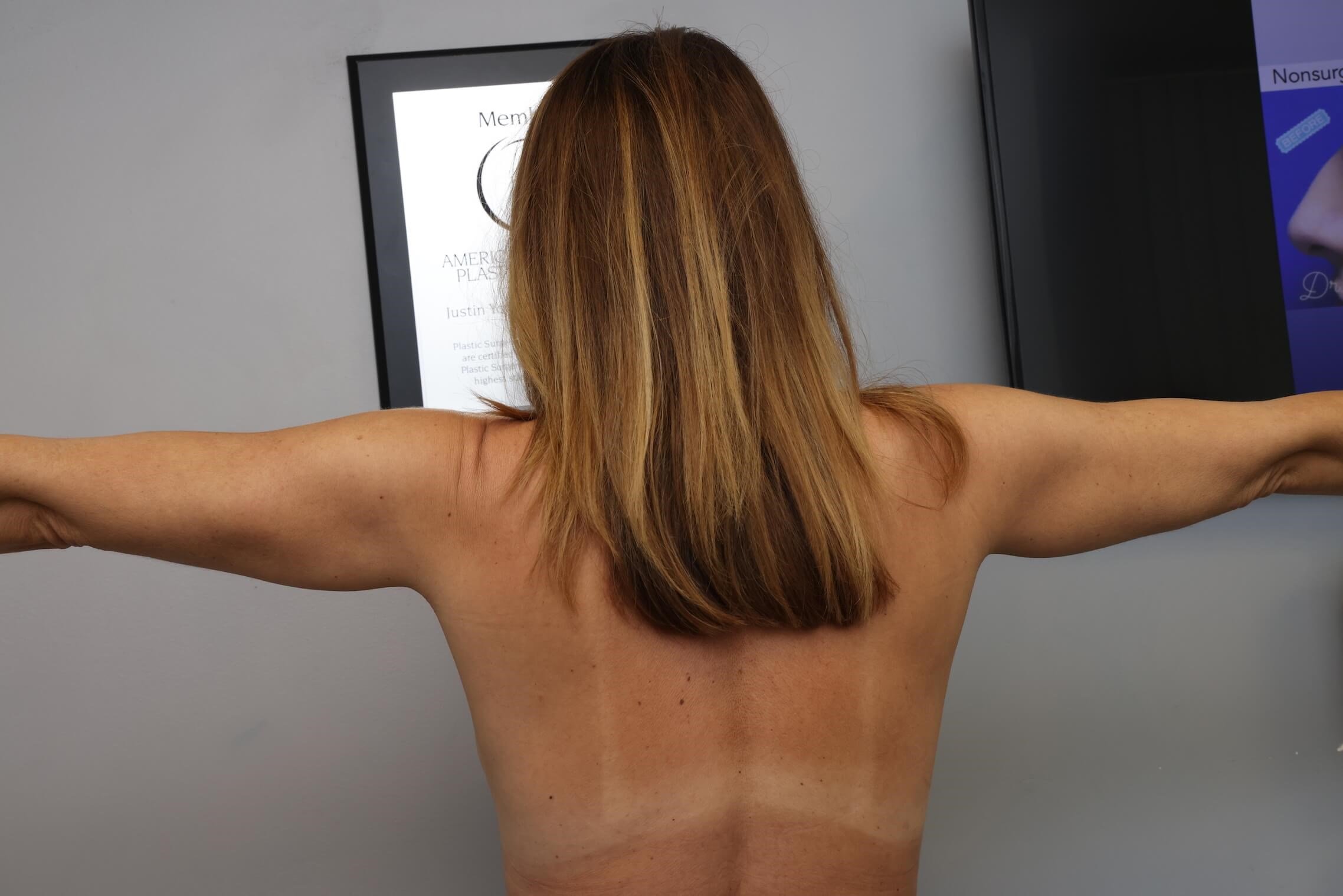 Awake Arm Liposuction After