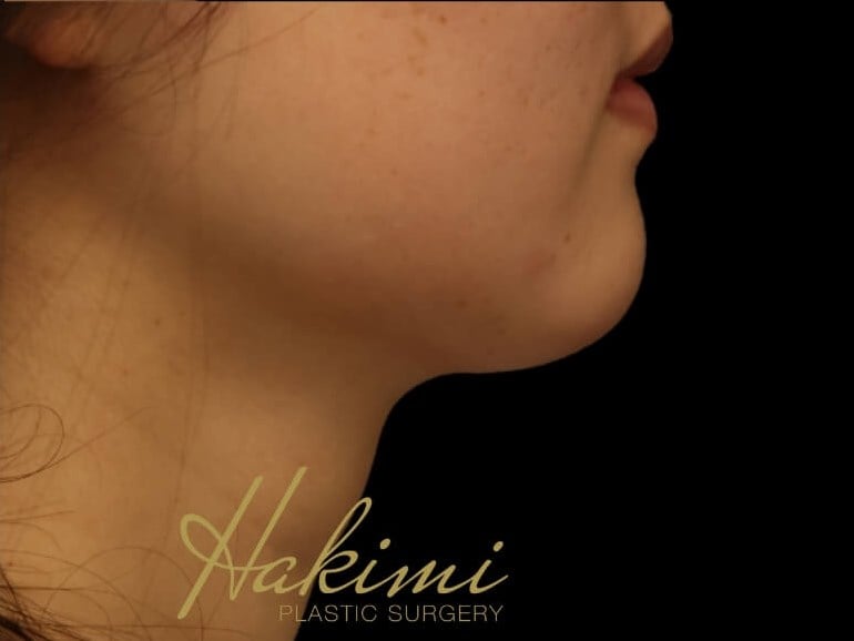 Awake Neck Liposuction After