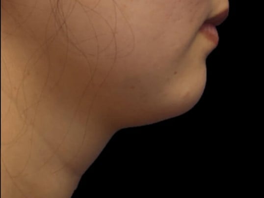 Awake Neck Liposuction Before