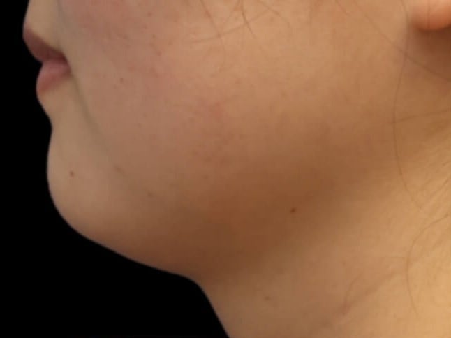 Awake Neck Liposuction Before