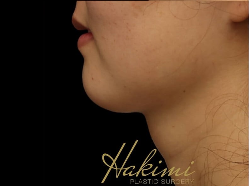 Awake Neck Liposuction After