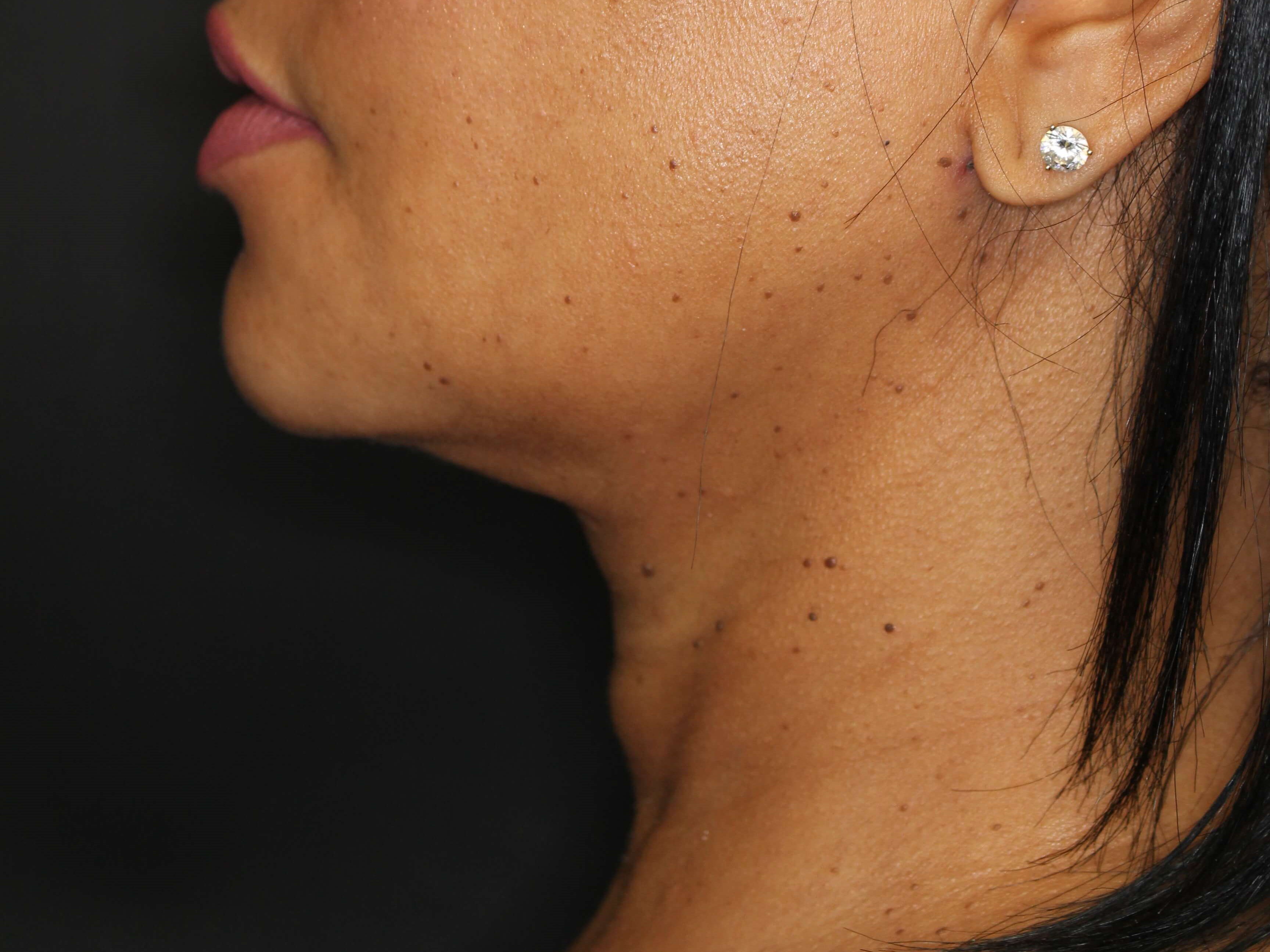 Awake Neck Liposuction Before