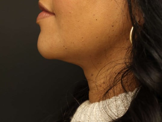 Awake Neck Liposuction After