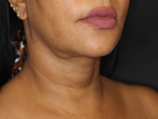 Awake Neck Liposuction Before