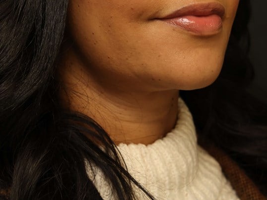 Awake Neck Liposuction After