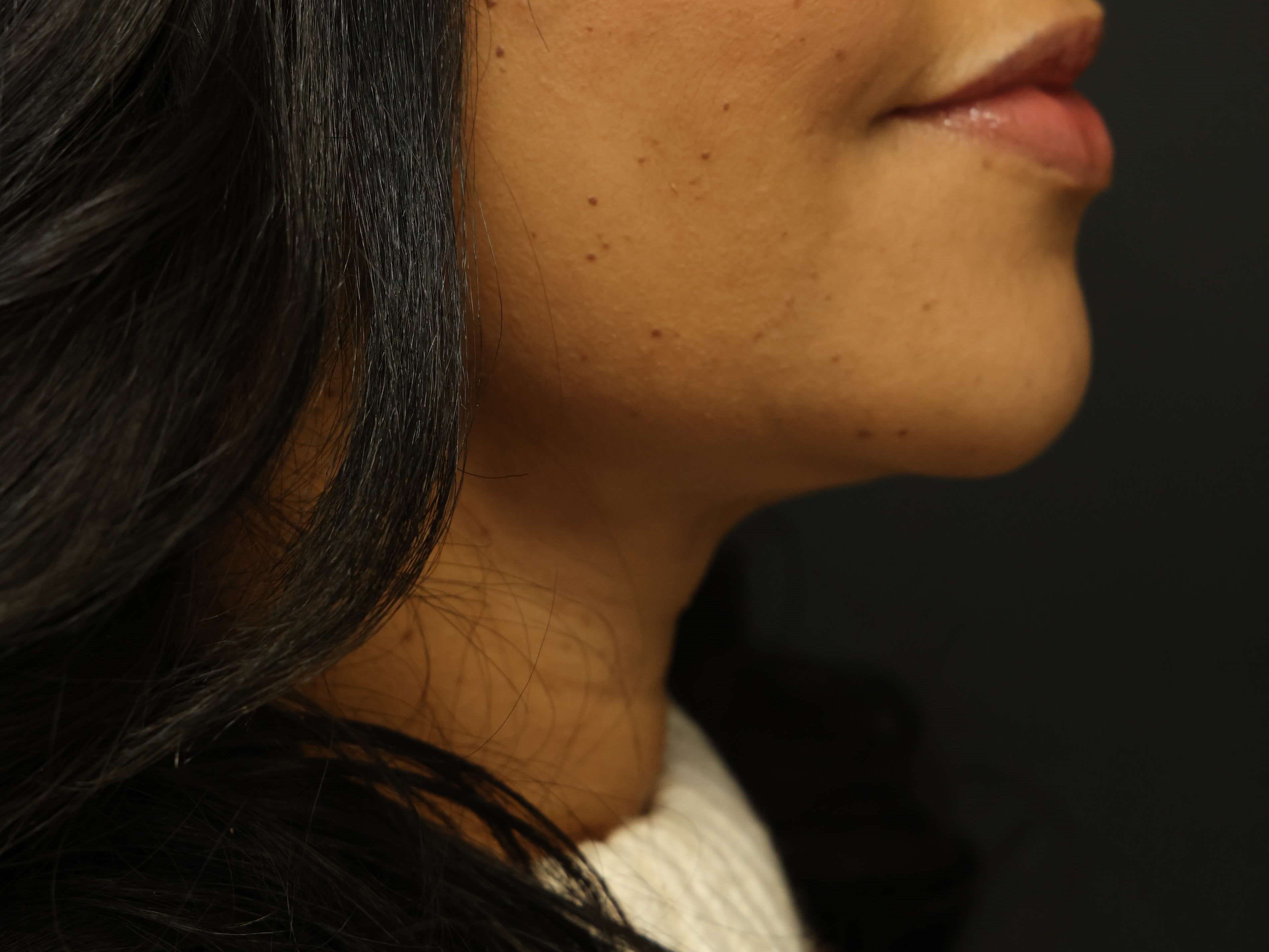 Awake Neck Liposuction After