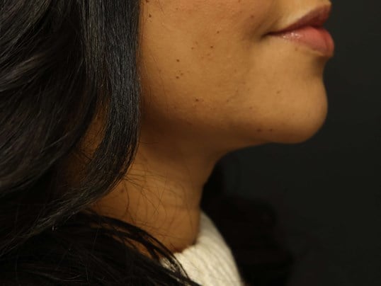 Awake Neck Liposuction After