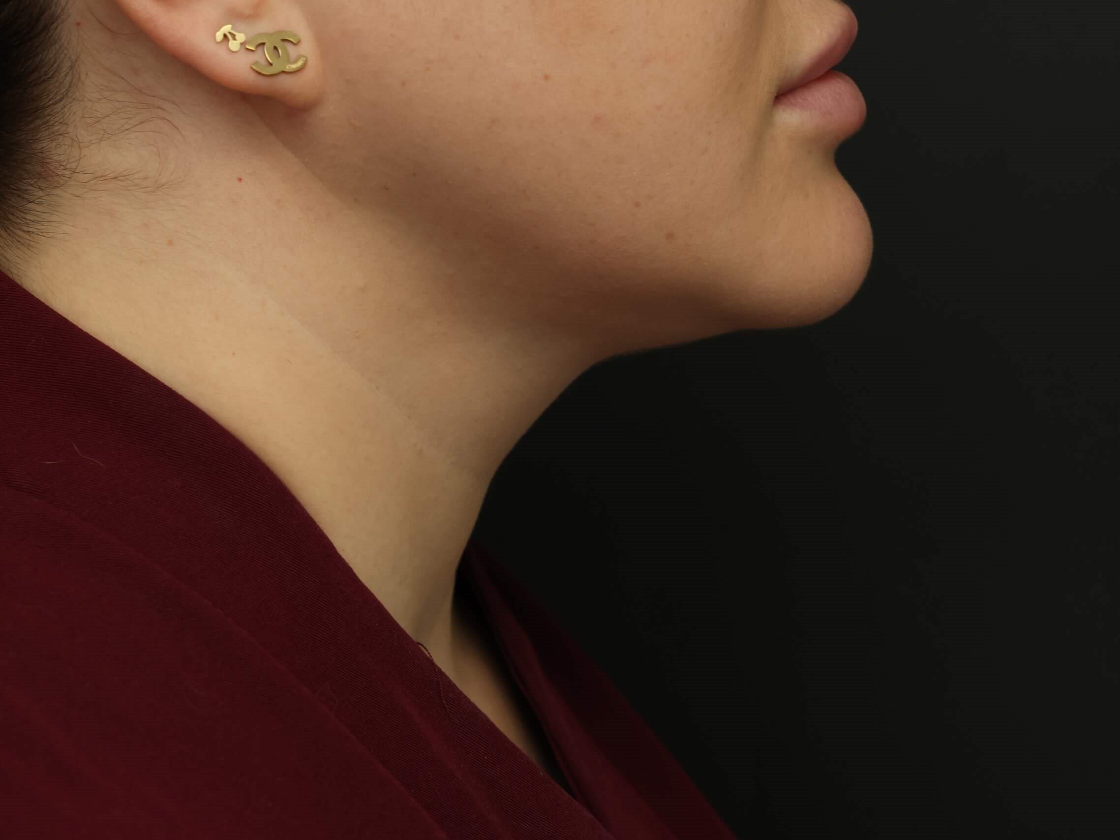 Awake Neck Liposuction After