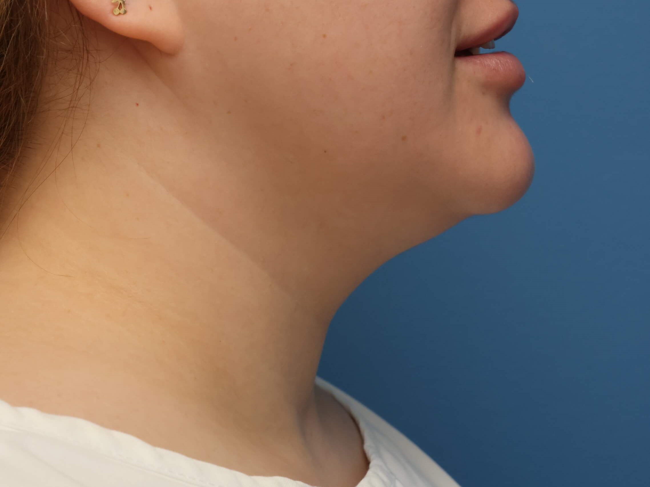 Awake Neck Liposuction Before