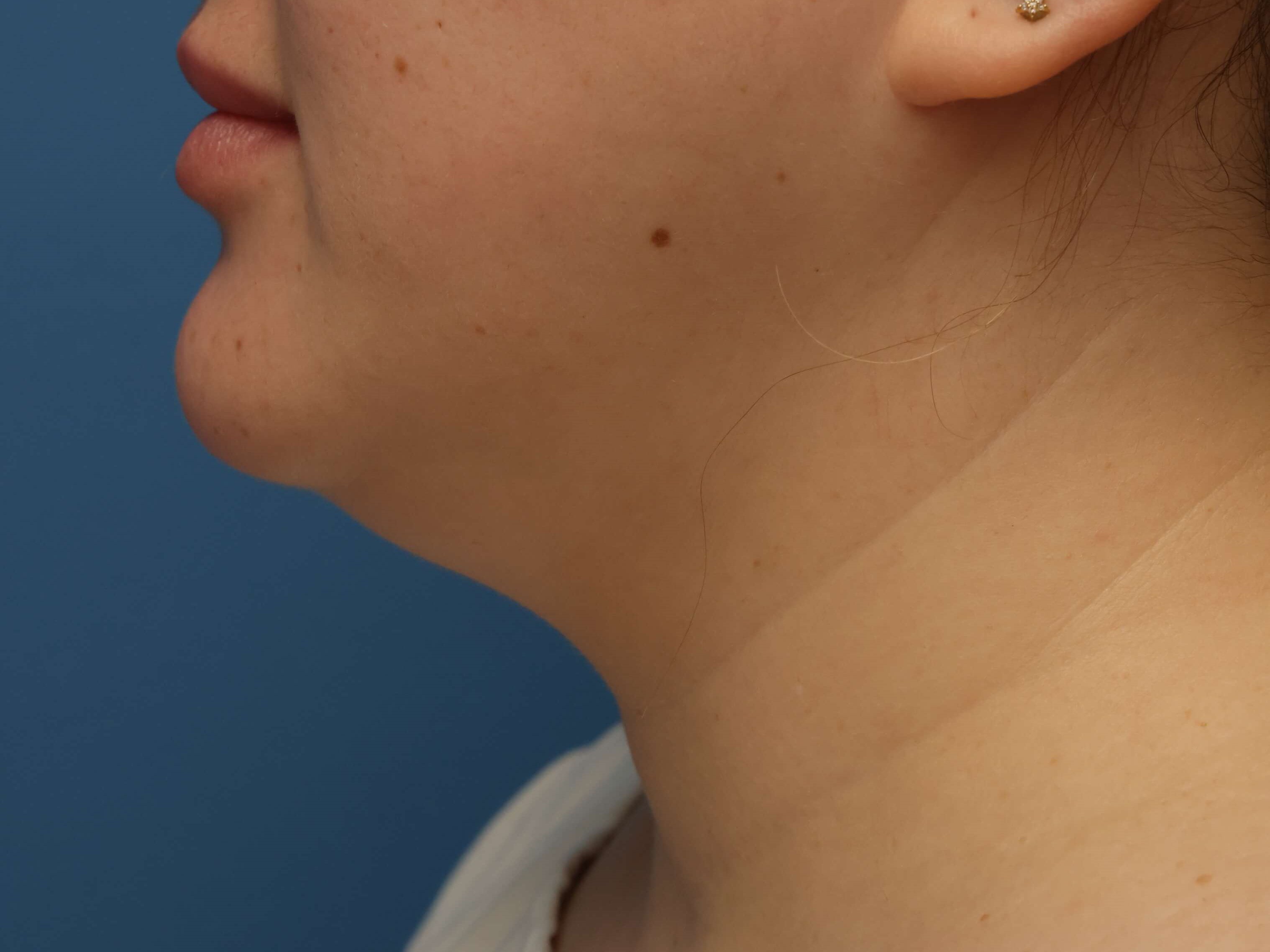Awake Neck Liposuction Before