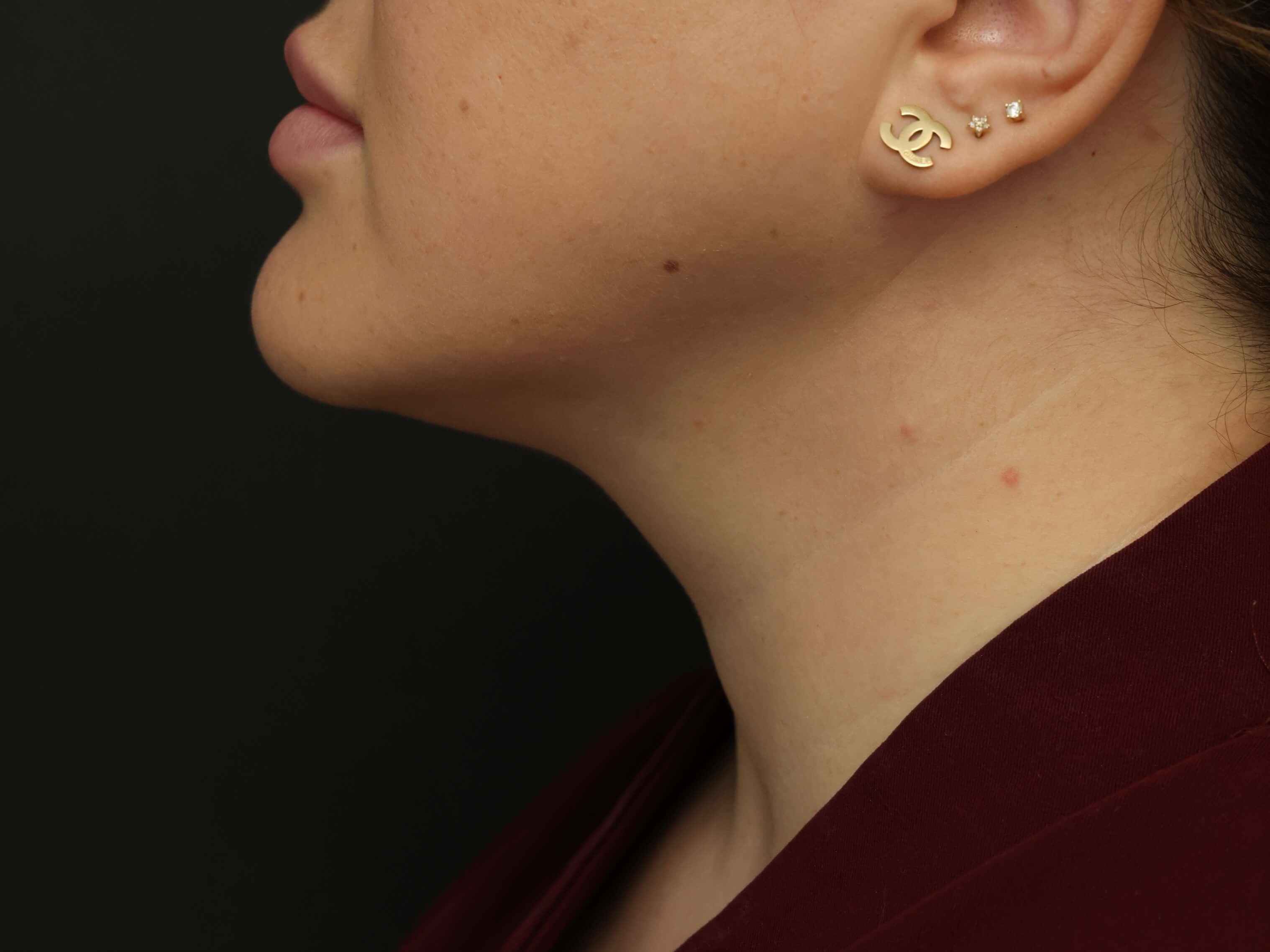 Awake Neck Liposuction After