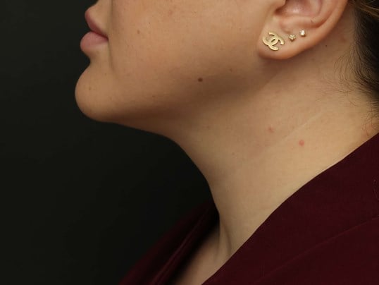 Awake Neck Liposuction After