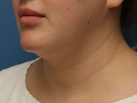 Awake Neck Liposuction Before