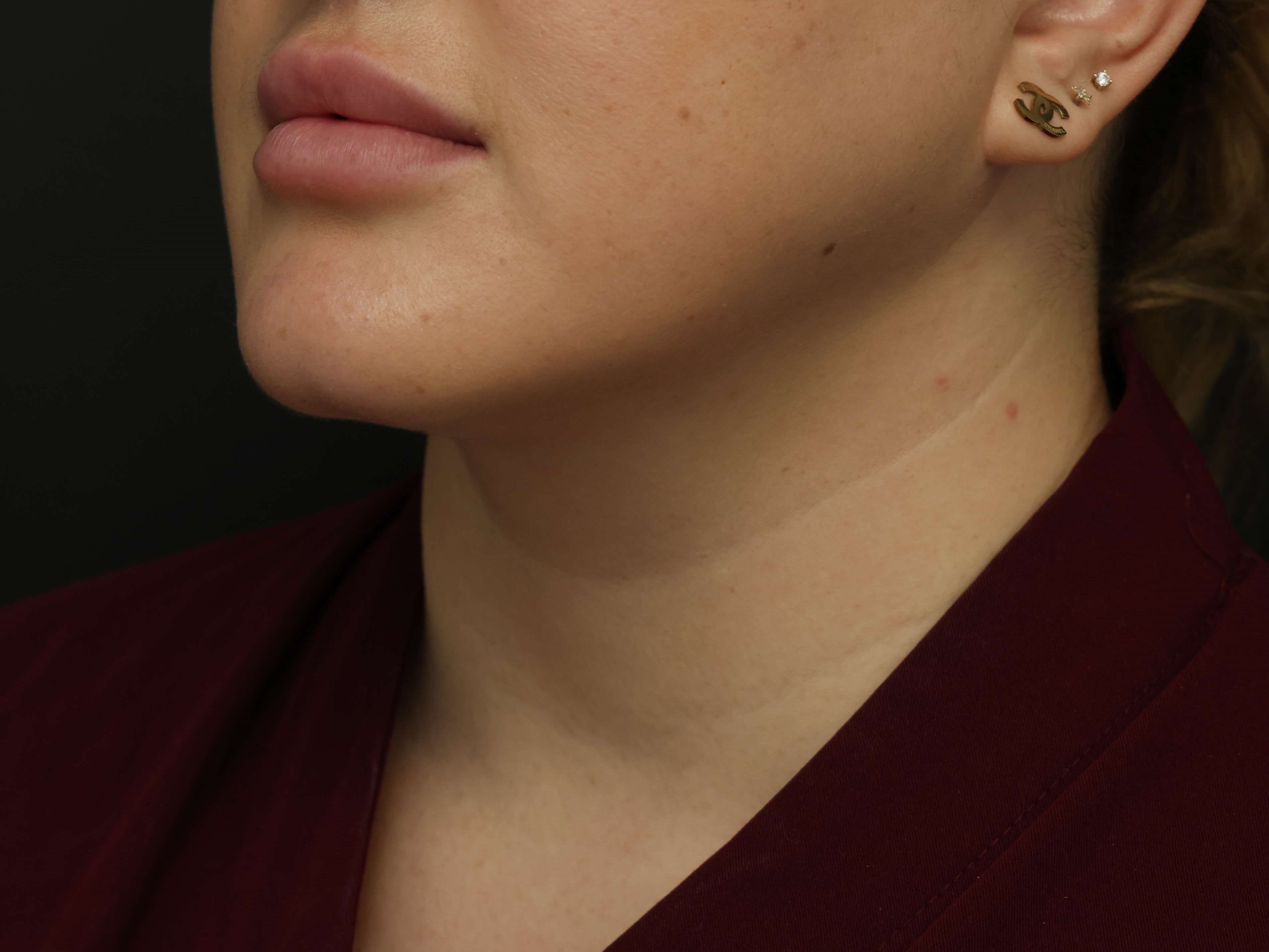 Awake Neck Liposuction After