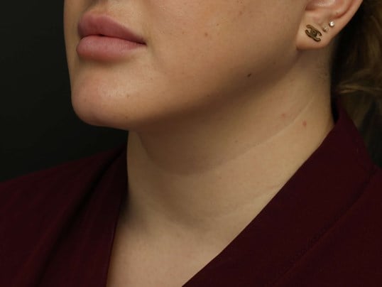Awake Neck Liposuction After