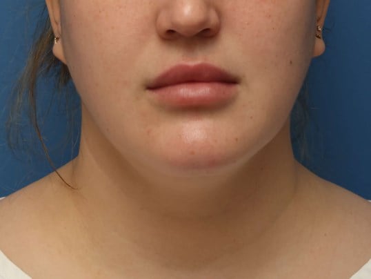 Awake Neck Liposuction Before