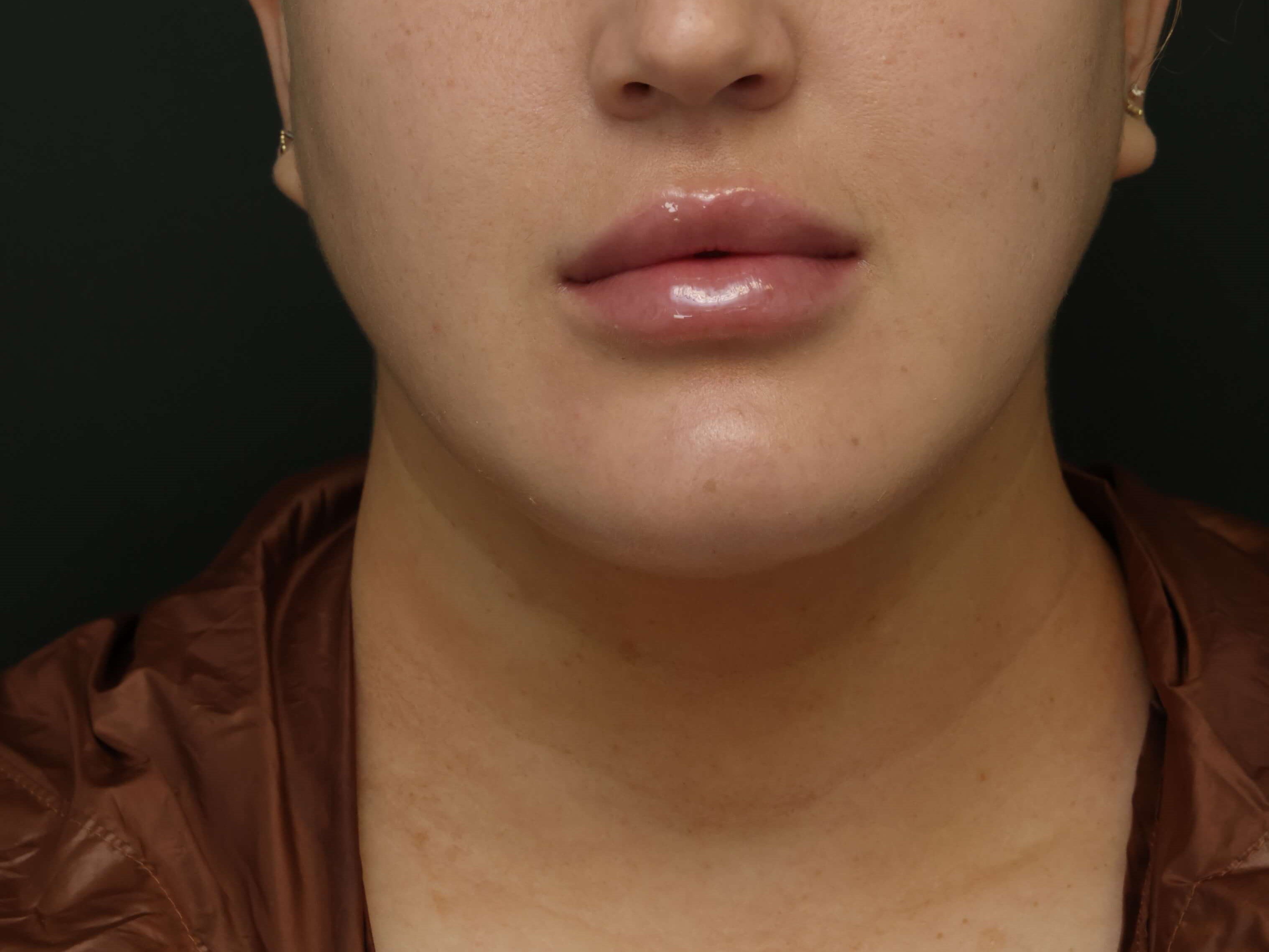 Awake Neck Liposuction After